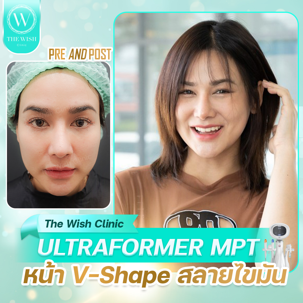 ultraformer mpt