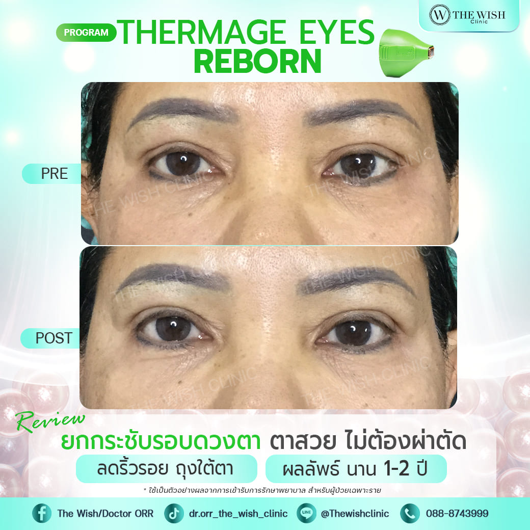 thermage