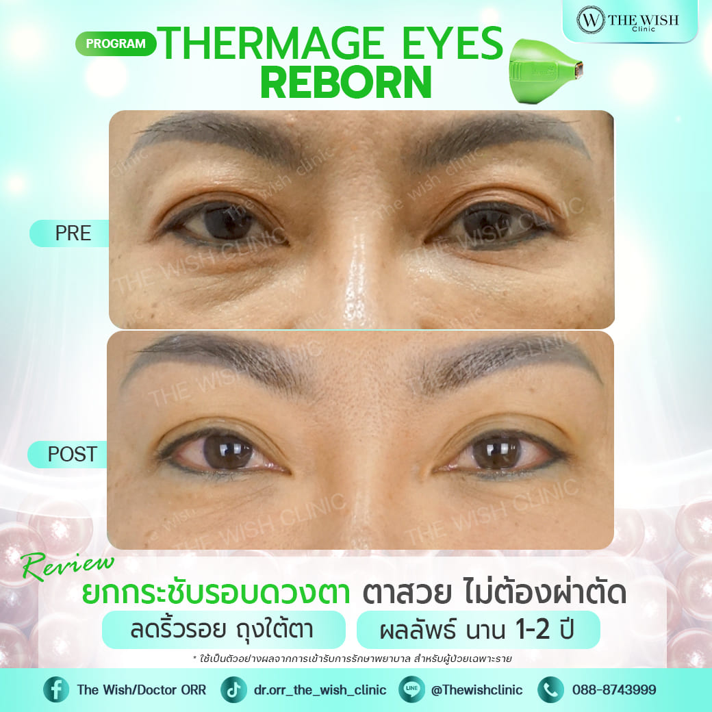 thermage