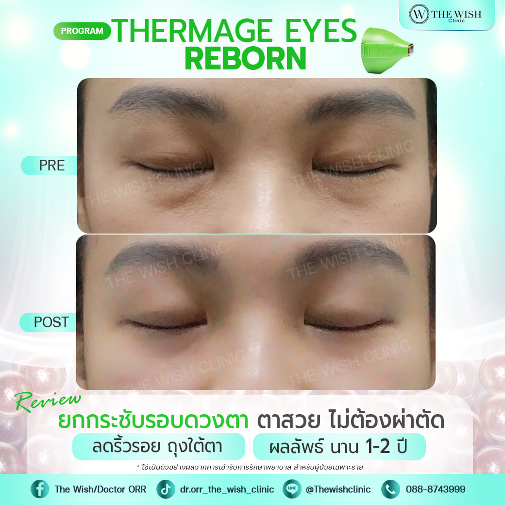 thermage