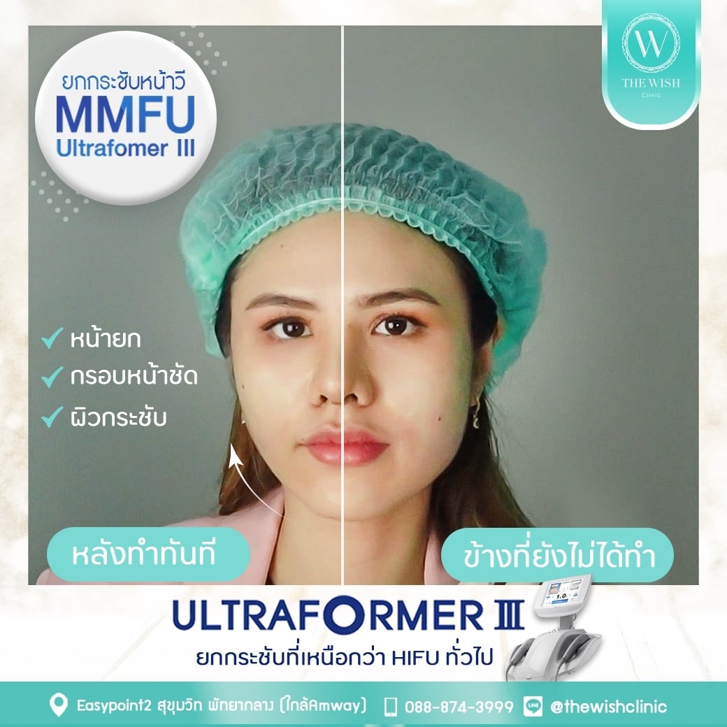 ultraformer