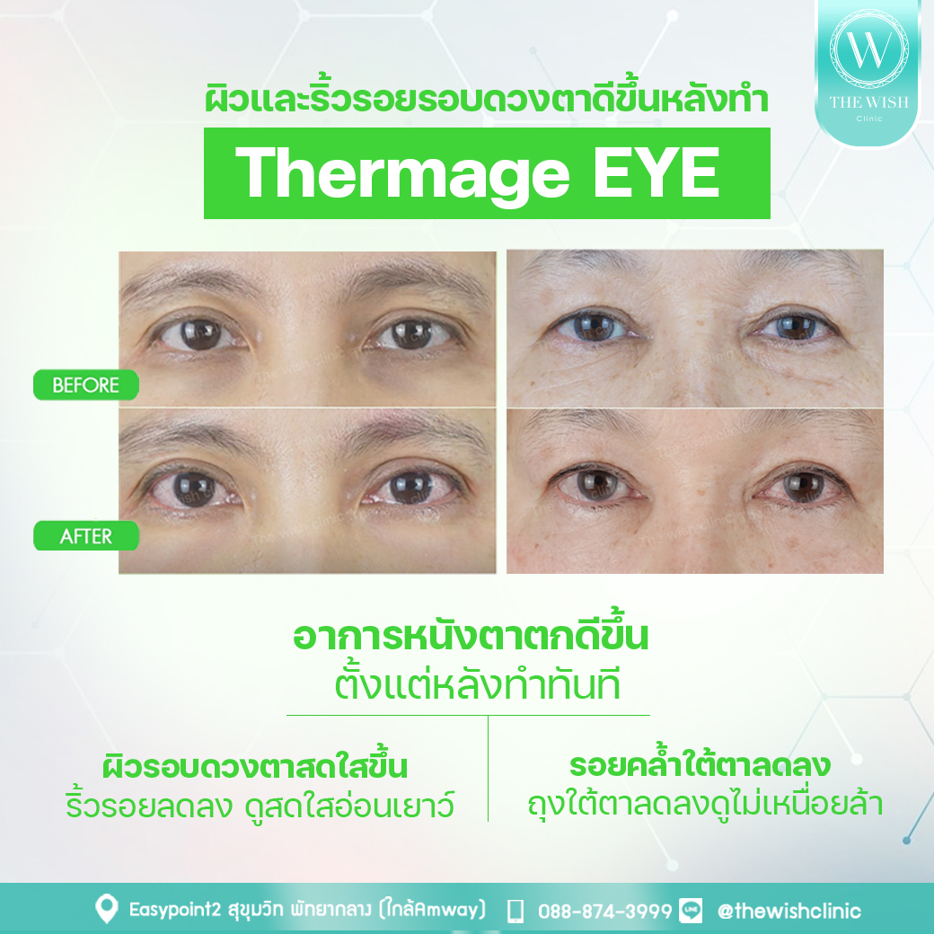 thermage