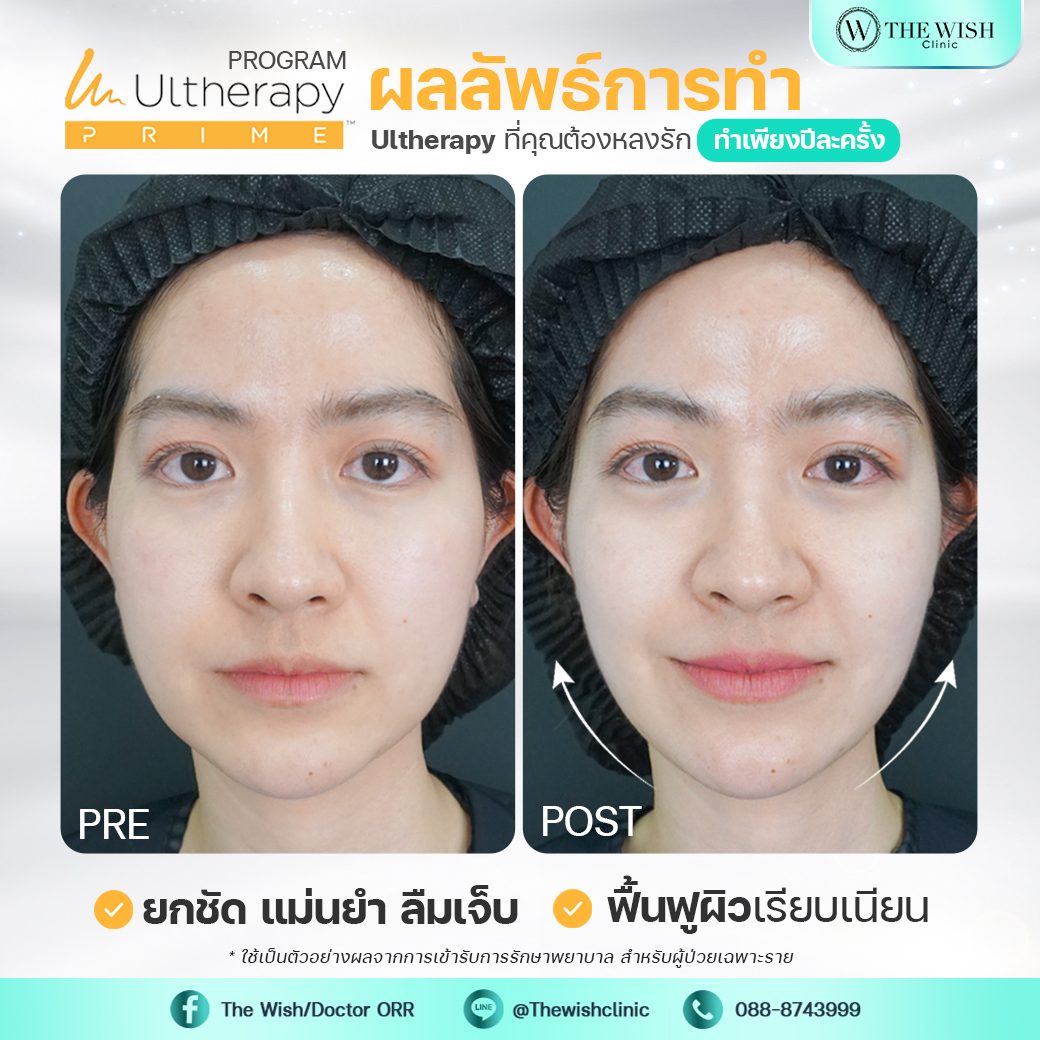 ultherapy prime