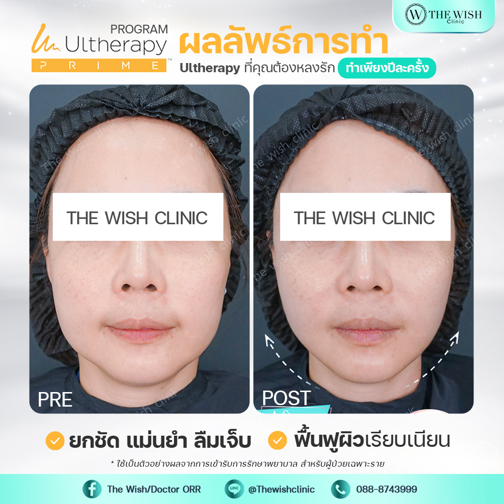 ultherapy prime