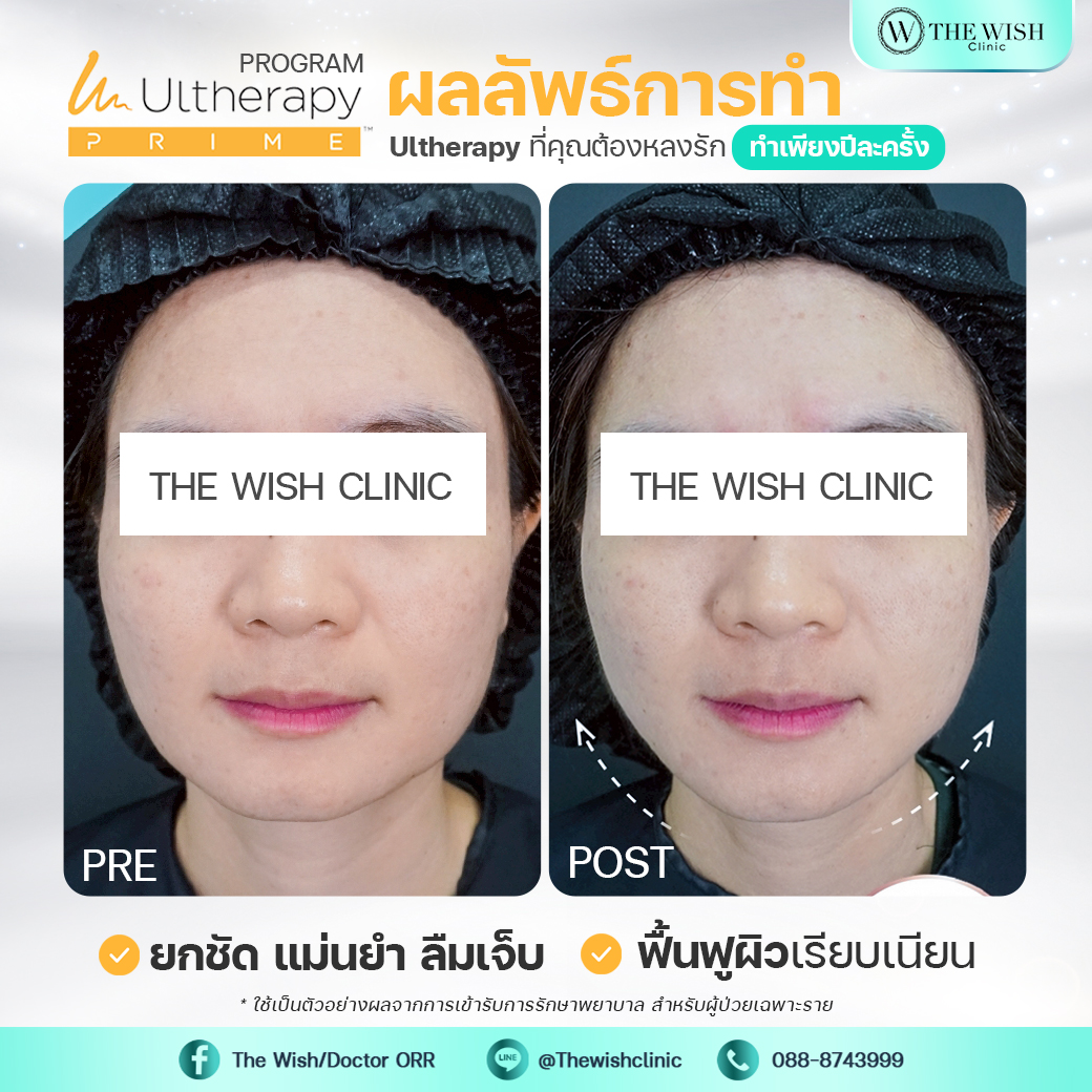 ultherapy prime