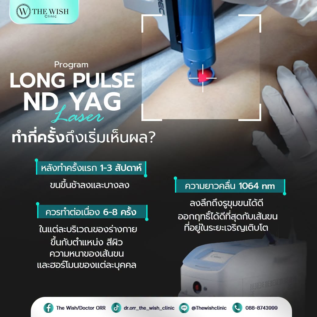 longpulse nd yag