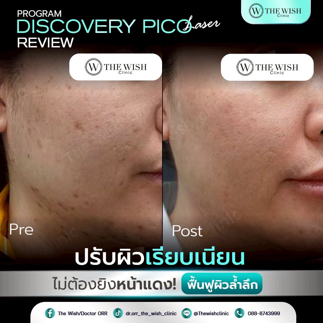 discovery pico