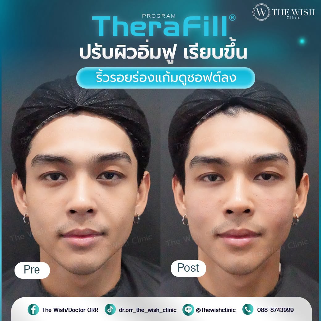 therafill
