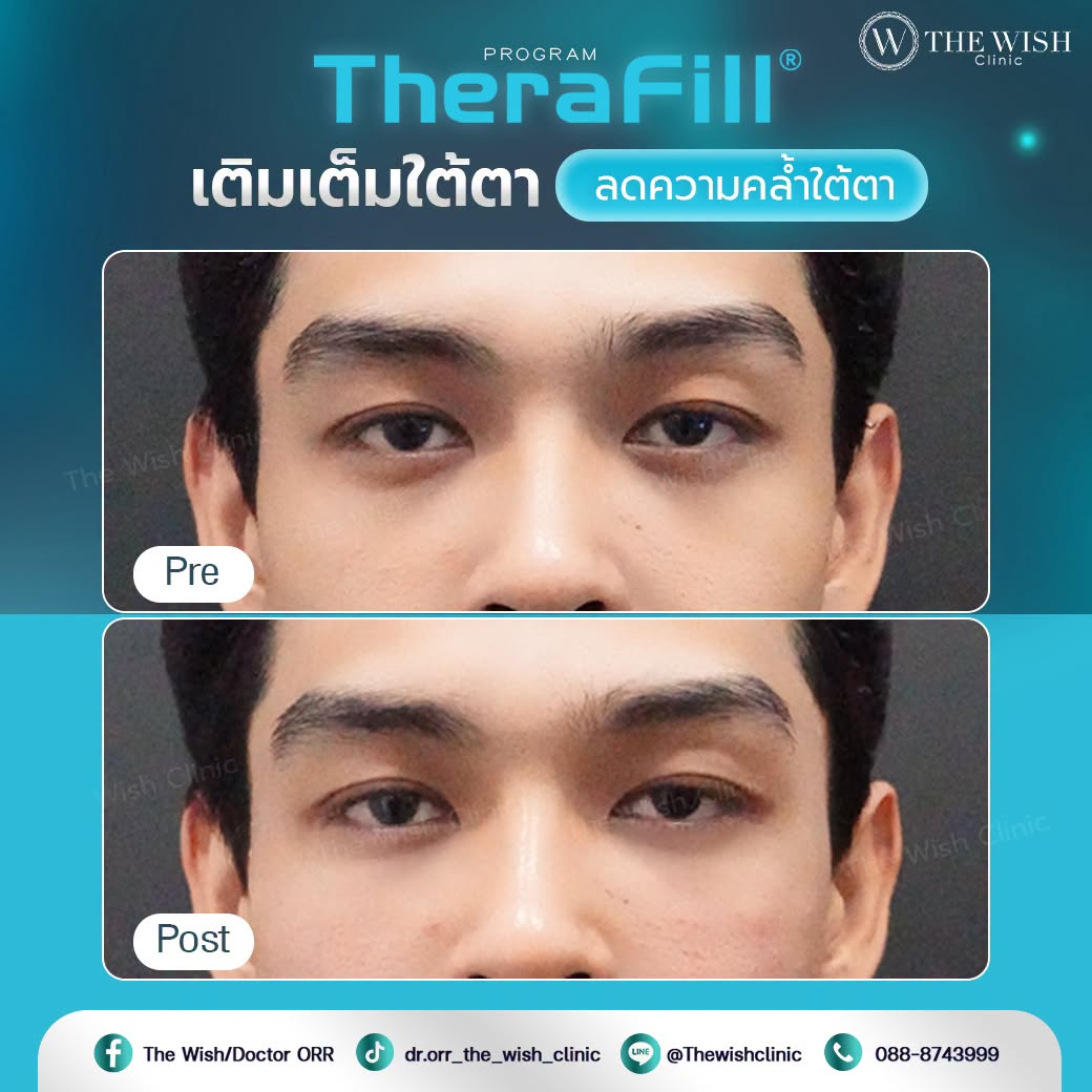 therafill
