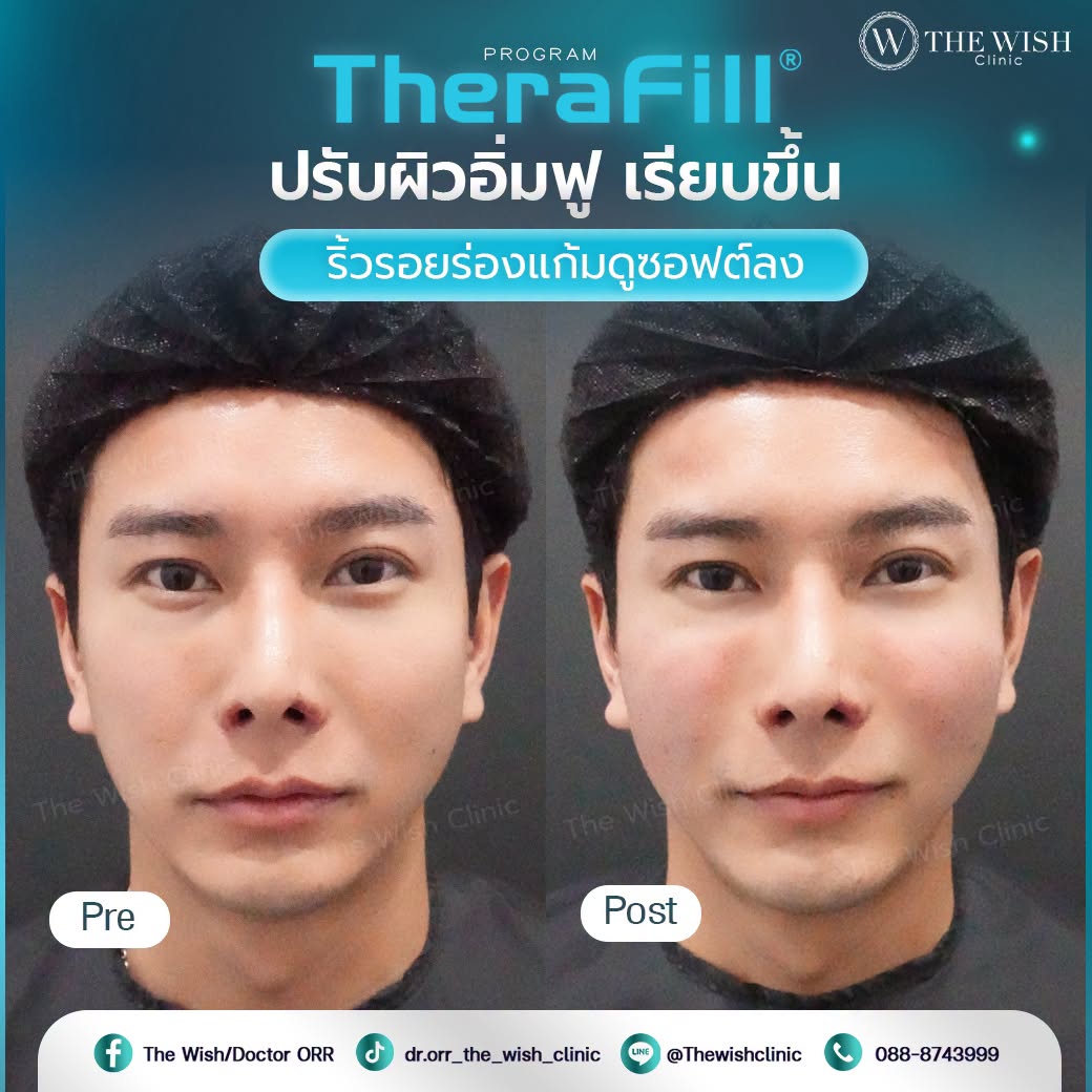 therafill