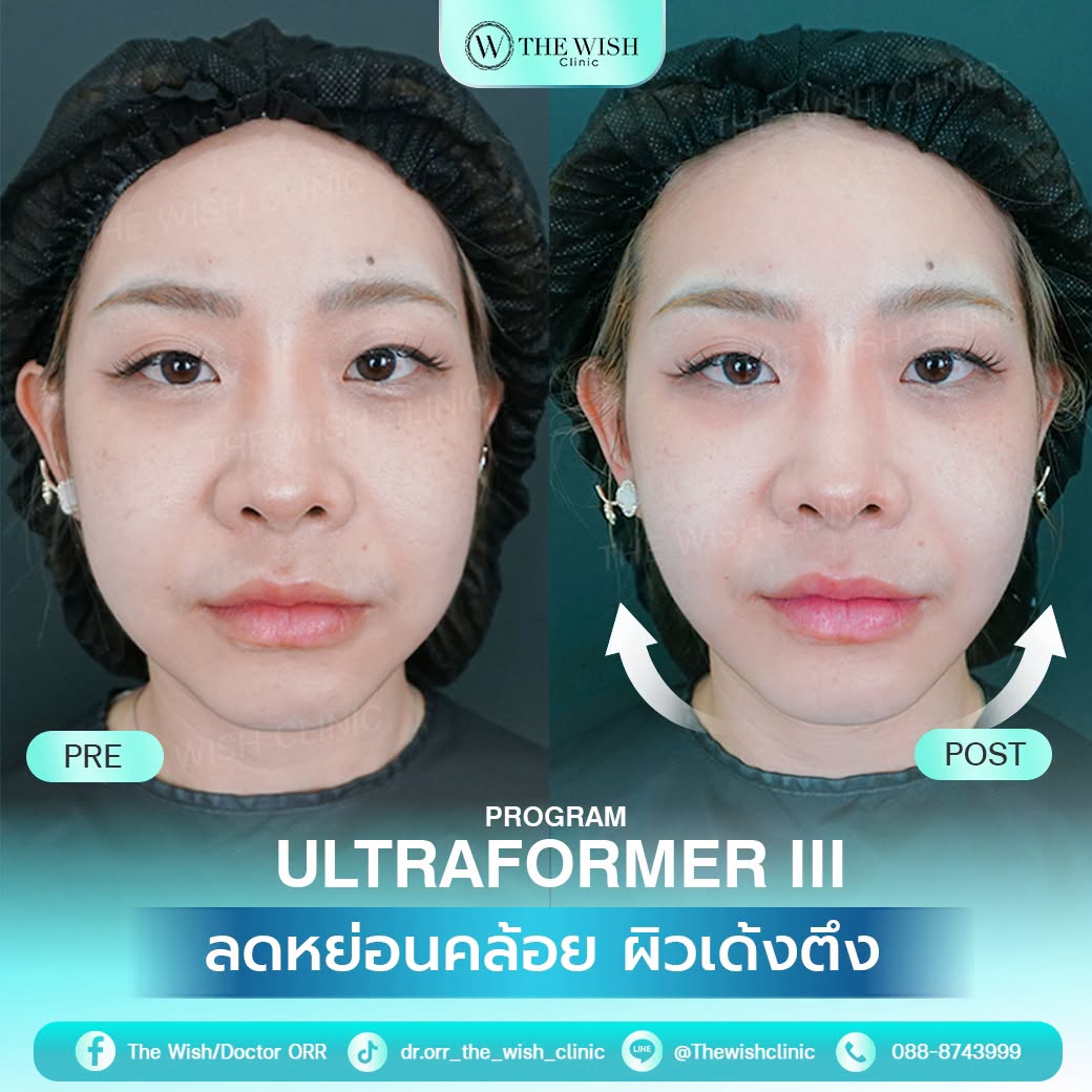 ultraformer III MMFU