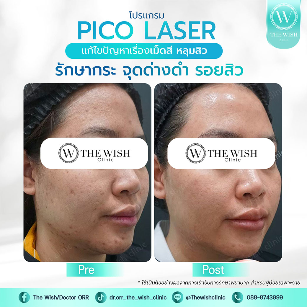 pico laser