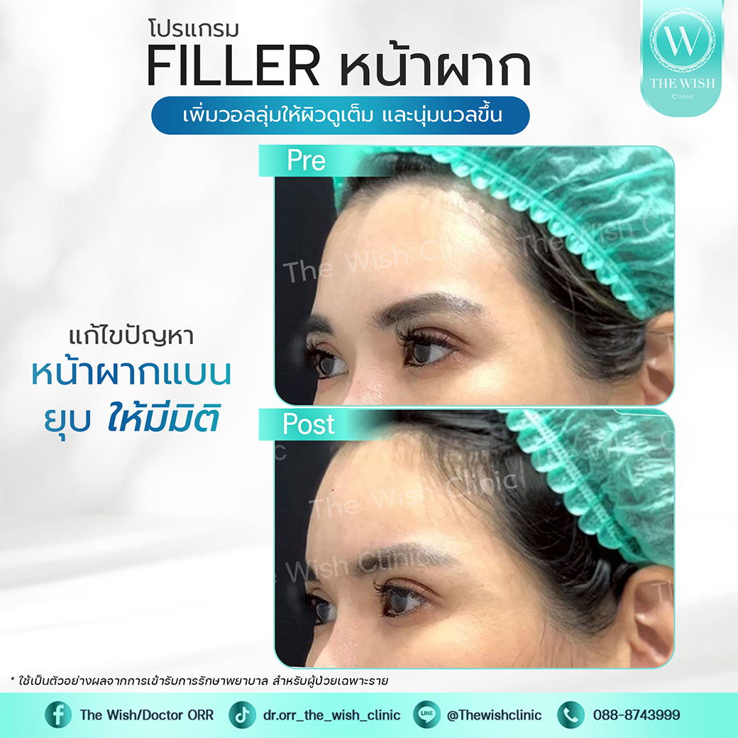 filler