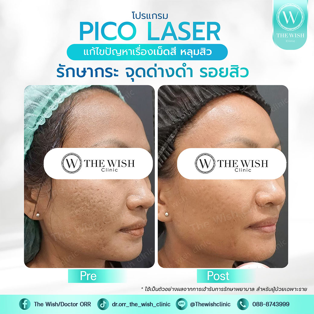 pico laser