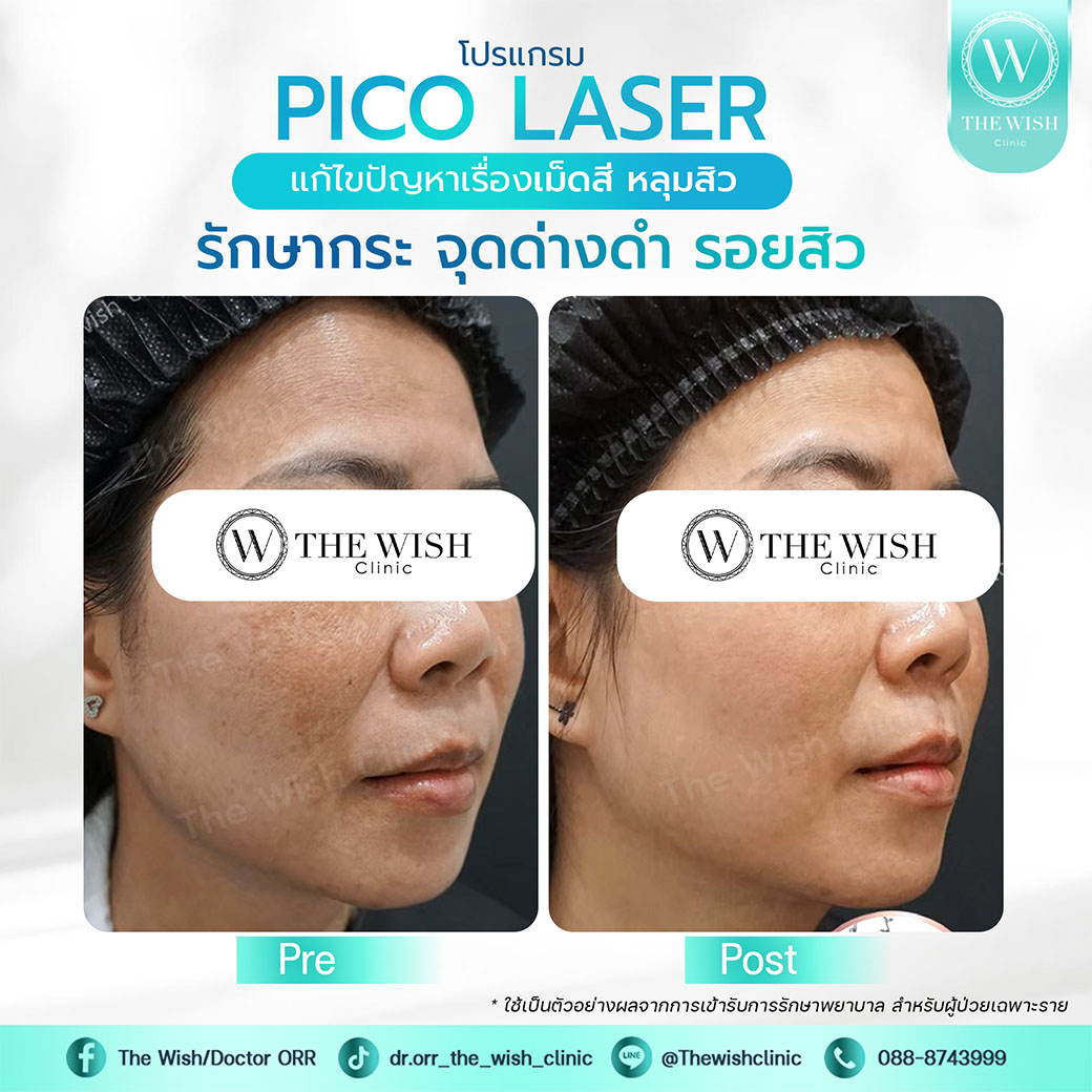 pico laser