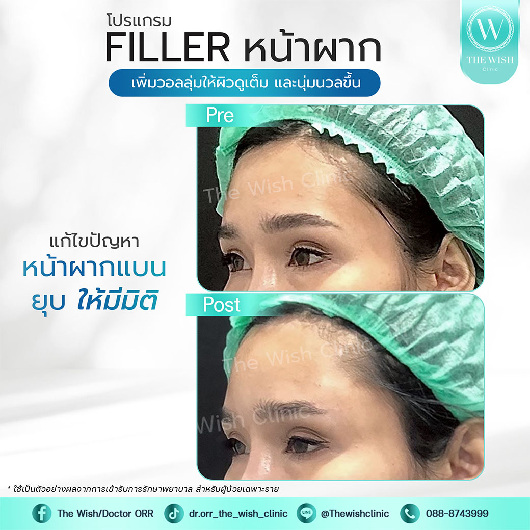 filler