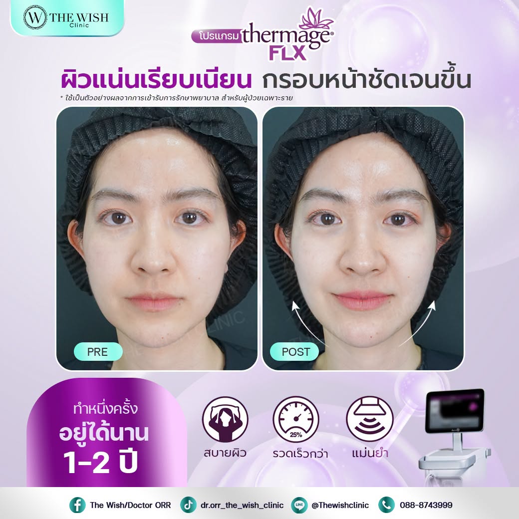thermage flx