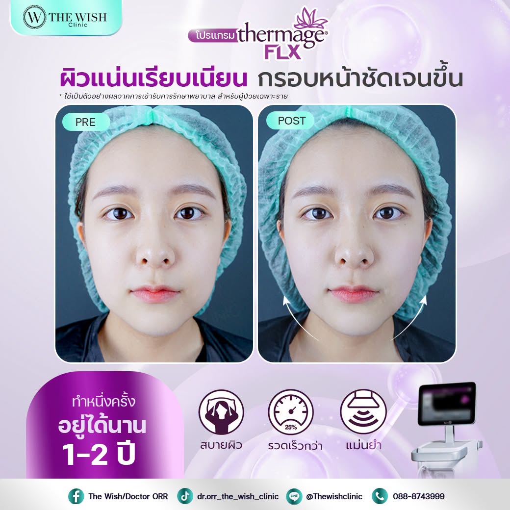 thermage flx
