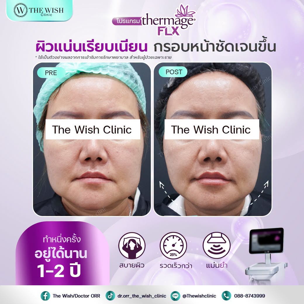 thermage flx