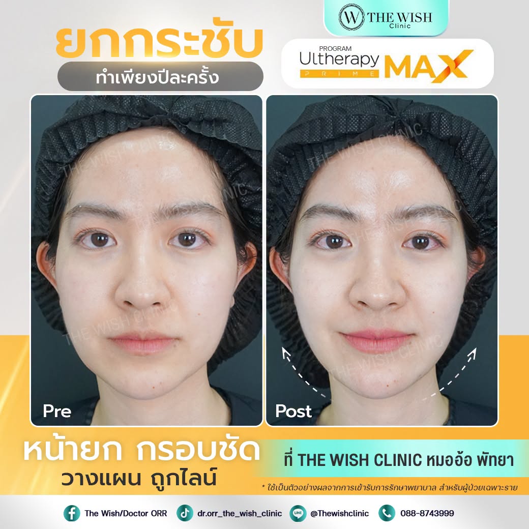 ultherapy