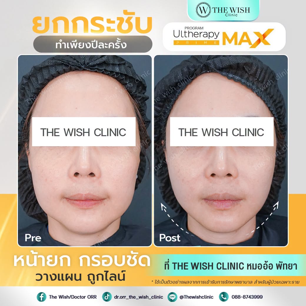 ultherapy