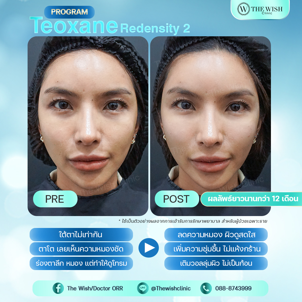 teoxane