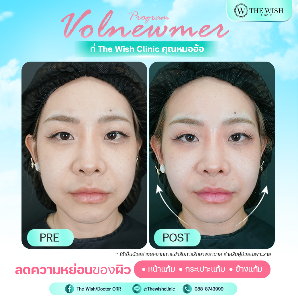 Volnewmer