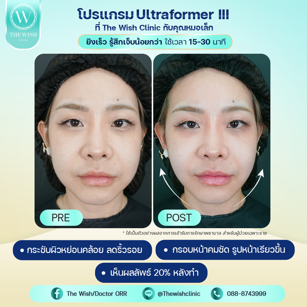 ultraformer III