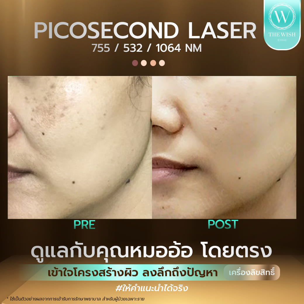 picosecond laser