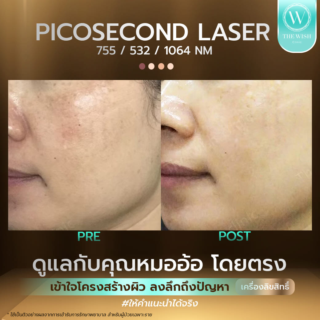 picosecond laser