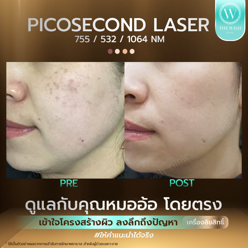 picosecond laser