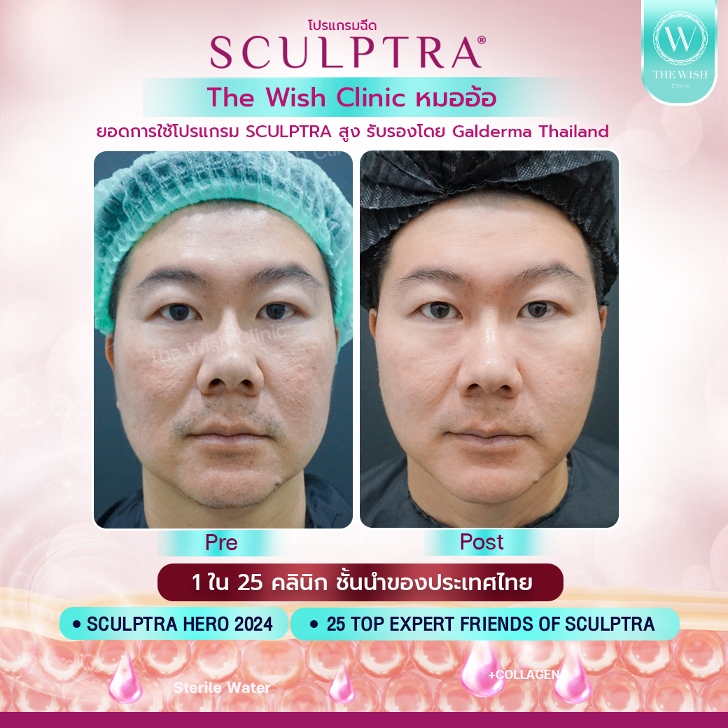 sculptra