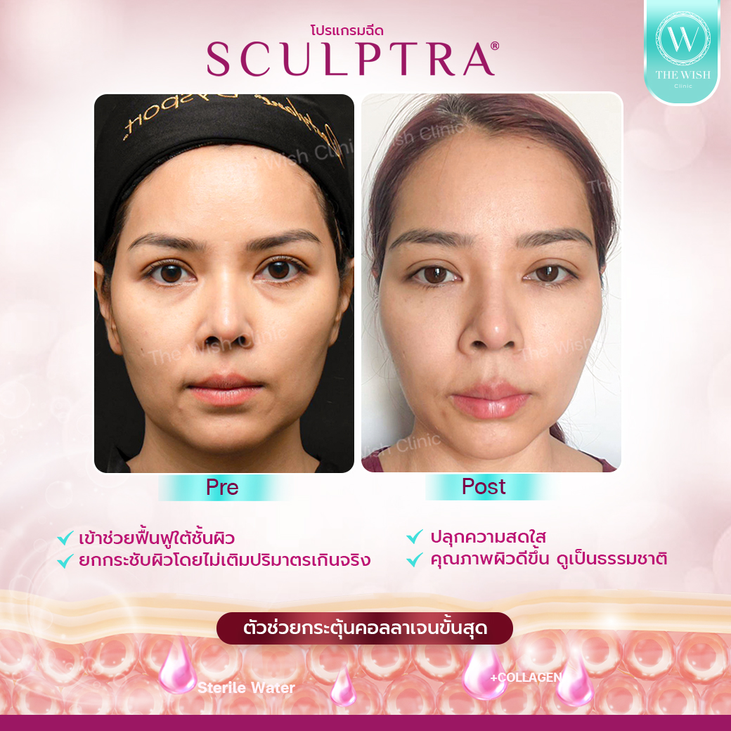 sculptra