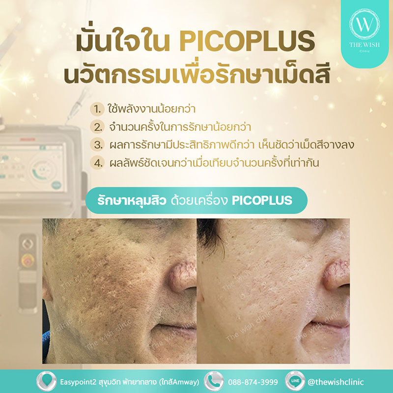 POICOPLUS LASER