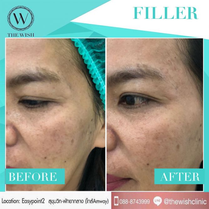 Filler before after