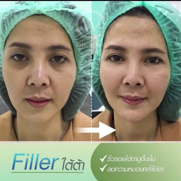 Filler before after2