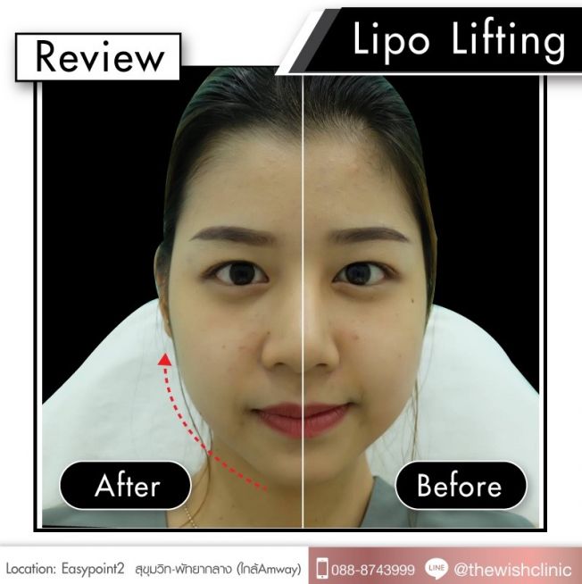 Review LIPO