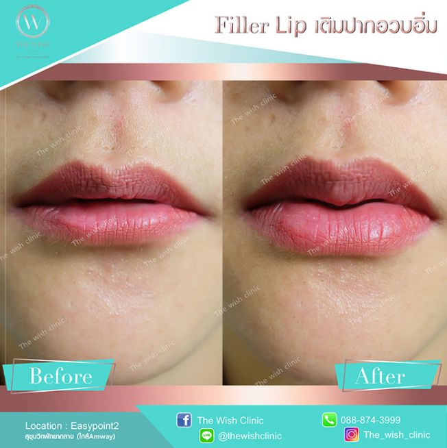 Review Filler ปาก