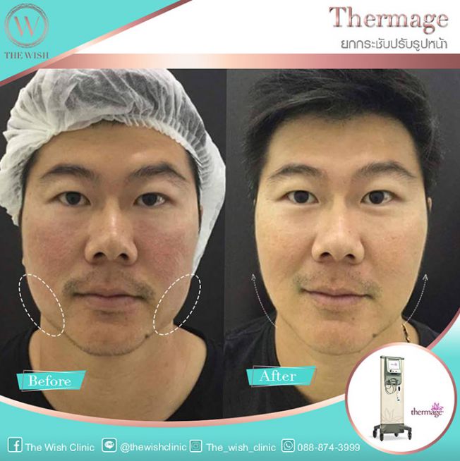 Review Thermage