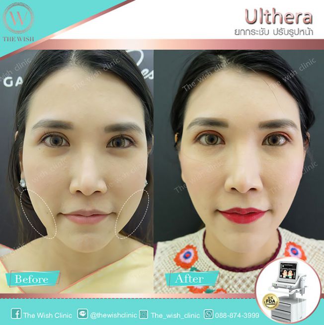 Review Ulthera