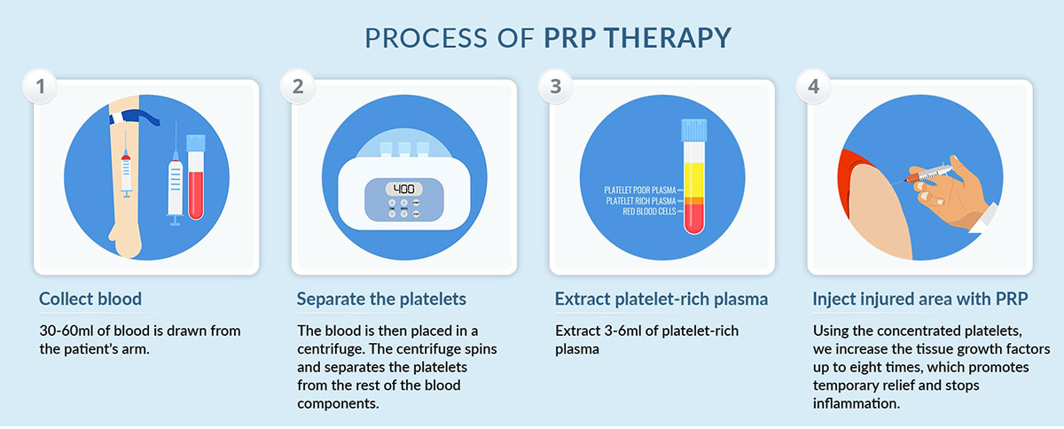 Process of PRP Therapy