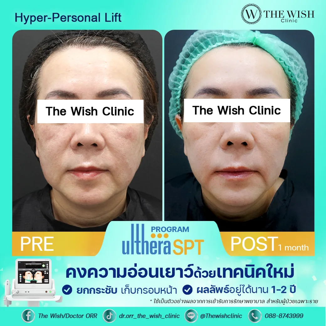 ultherapy prime