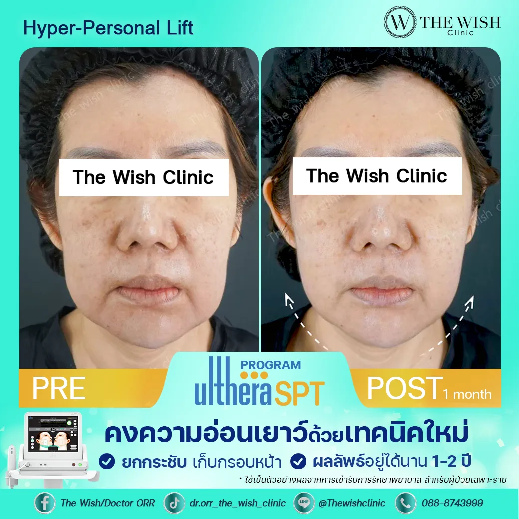 ultherapy prime