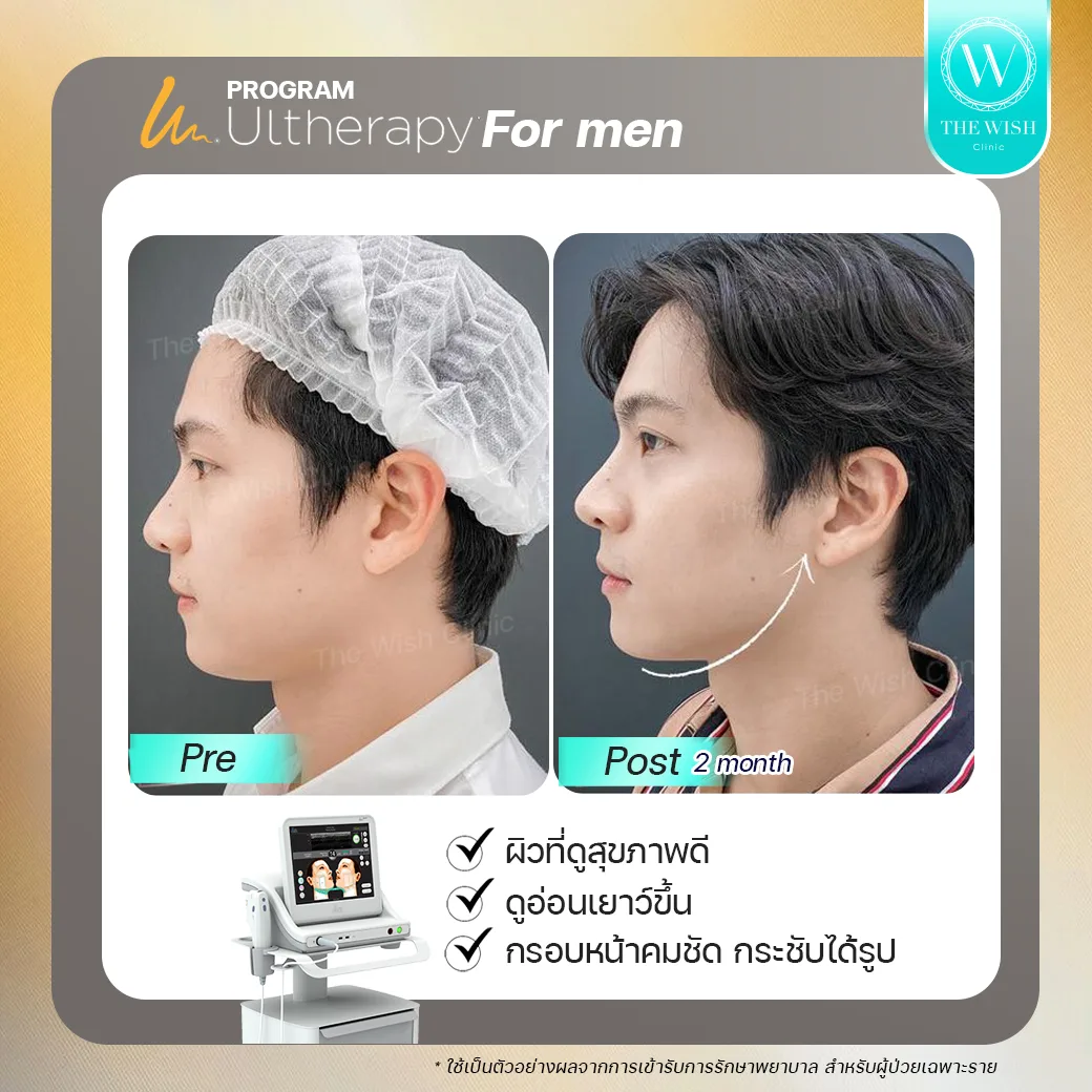 ultherapy prime