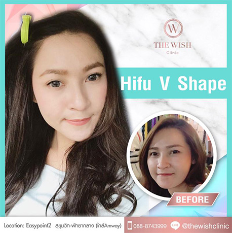 hifu a3